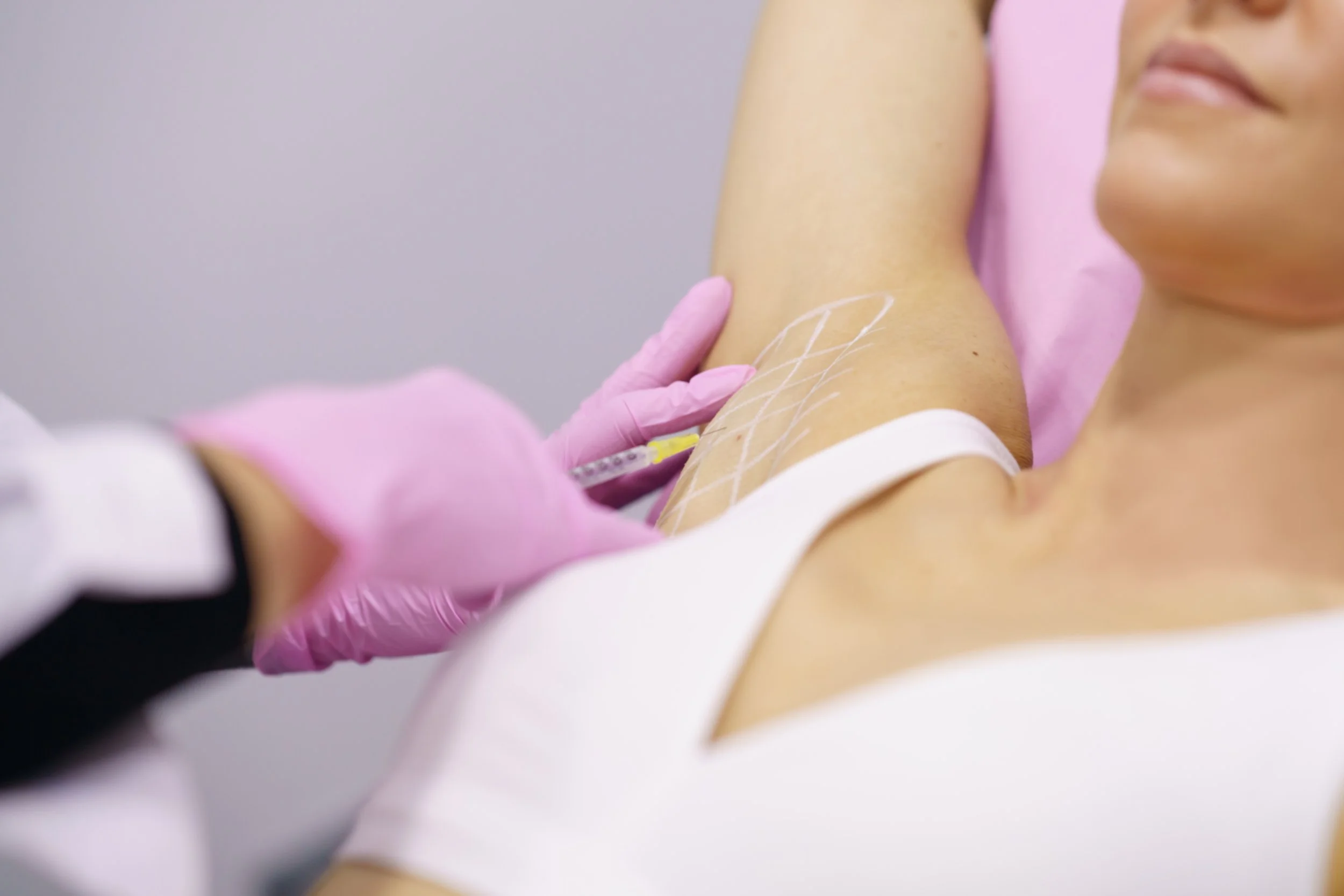 Hyperhidrosis treatment
