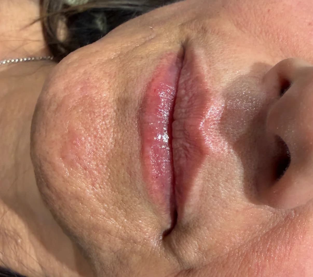 Lips after dermal filler treatment, second example
