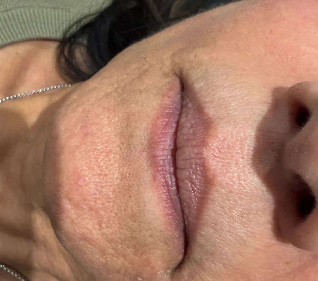 Lips before dermal filler treatment, second example