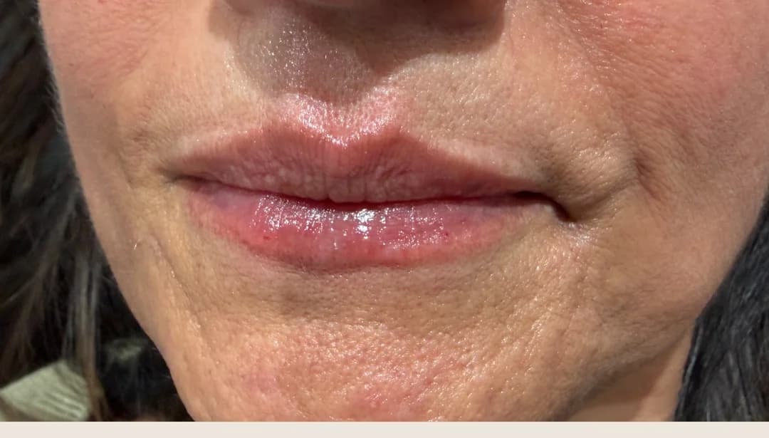 Lips after dermal filler treatment