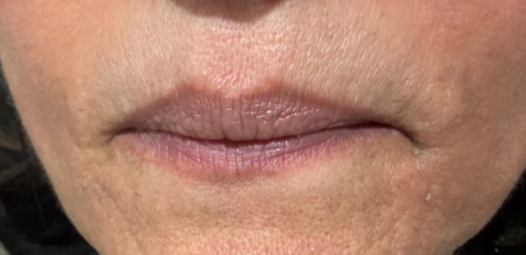 Lips before dermal filler treatment